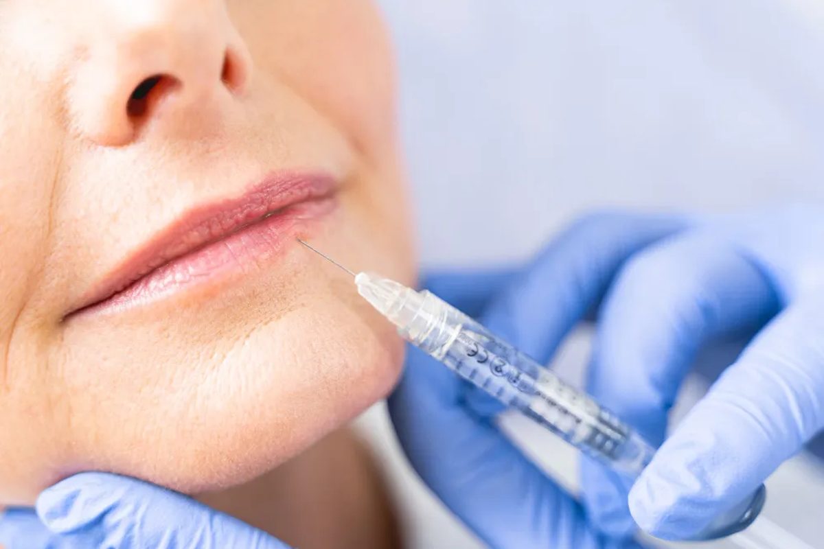 Restylane dermal filler