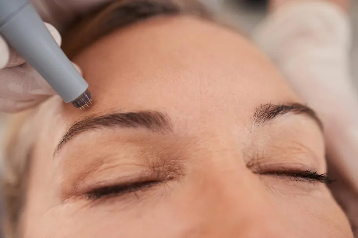 Scarlet RF Microneedling